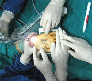 Ứng dụng phẫu thuật nội soi điều trị hội chứng ống cổ tay